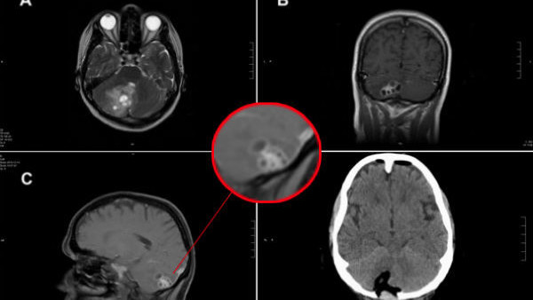 buzz lightyear x ray