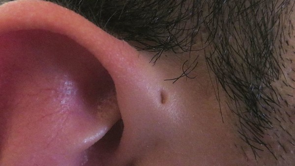 Preauricular sinus fish gill
