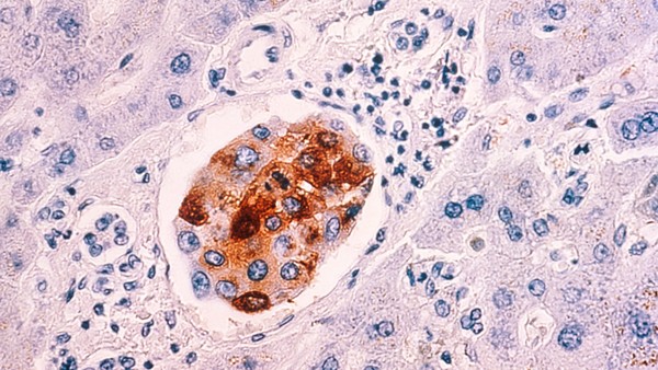 Breast Cancer Metastasis