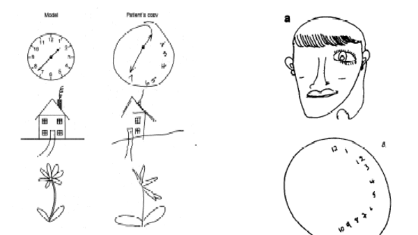 hemispatial neglect