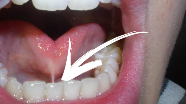 Frenum tongue