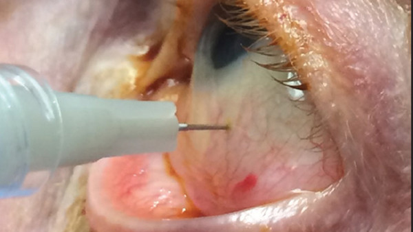 Needle eye