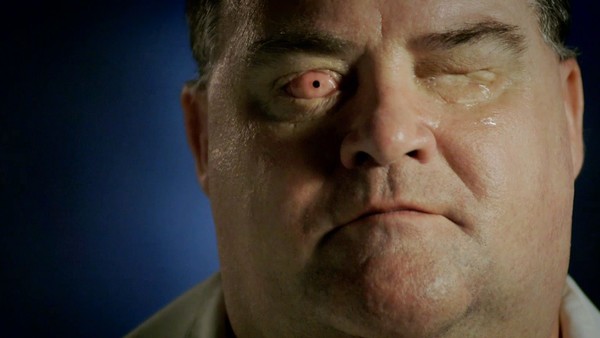 tooth in eye surgery