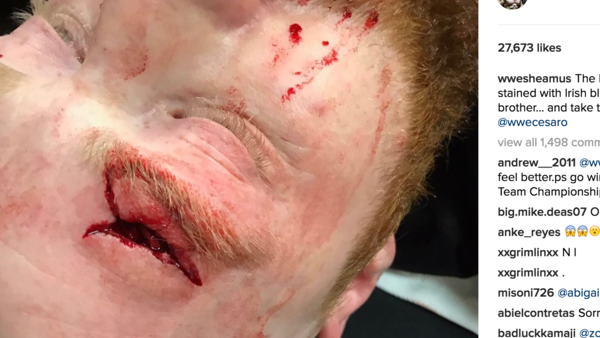 Sheamus Eye Instagram