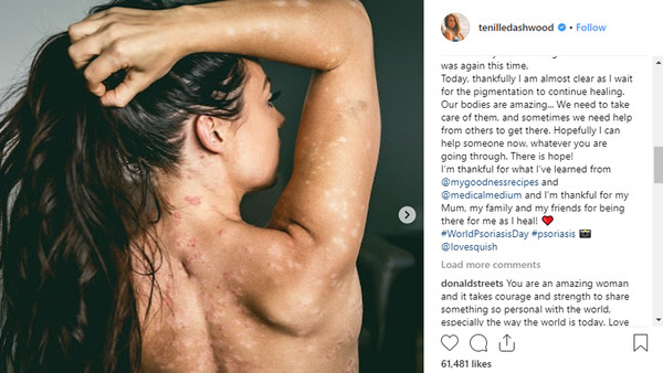Tenille Dashwood Psoriasis 2