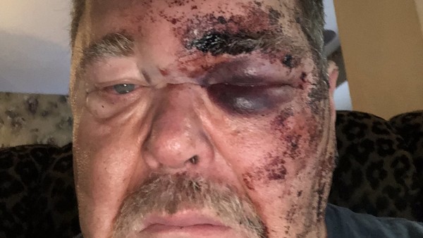 Jim Ross Broken Face