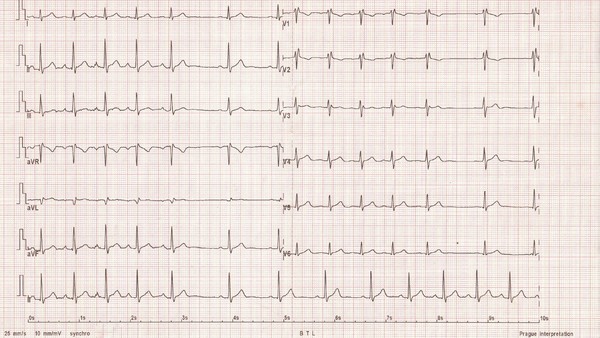 Respiratory sinus arrhythmia