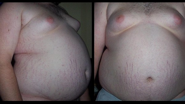 Obese Man