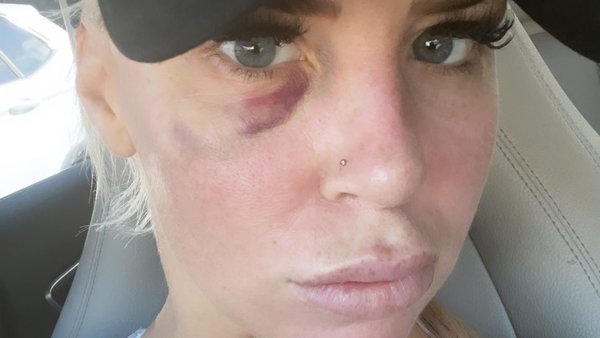 Dana Brooke Black Eye