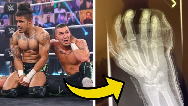 Wes Lee broken hand