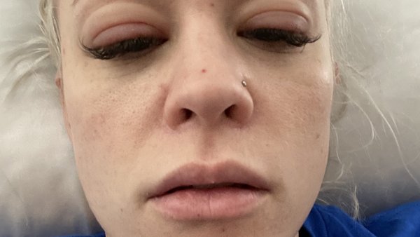 Penelope Ford Allergic Reaction